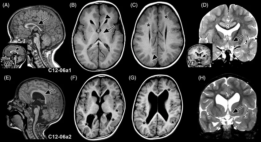 Magnetic Resonance Imaging (MRI) of the Brain